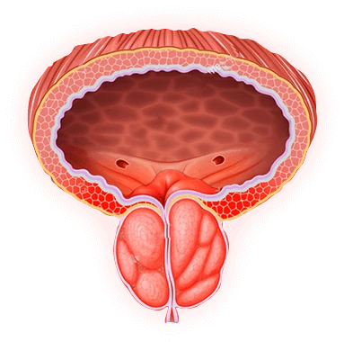 Ilustración de un hombre afectado por problemas de próstata